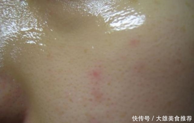 迹象|不管男女生，脸上出现3迹象，说明被螨虫缠上，3招把螨虫一窝端