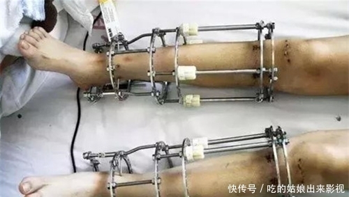 李亚诺|6年前,那个花16万,断骨增高7.2厘米高三男生,如今却后悔了