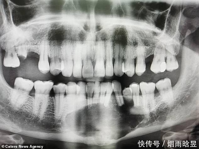  恐惧|英男子恐惧看牙医，27年后终做检查：下巴长拳头大肿瘤被迫摘除