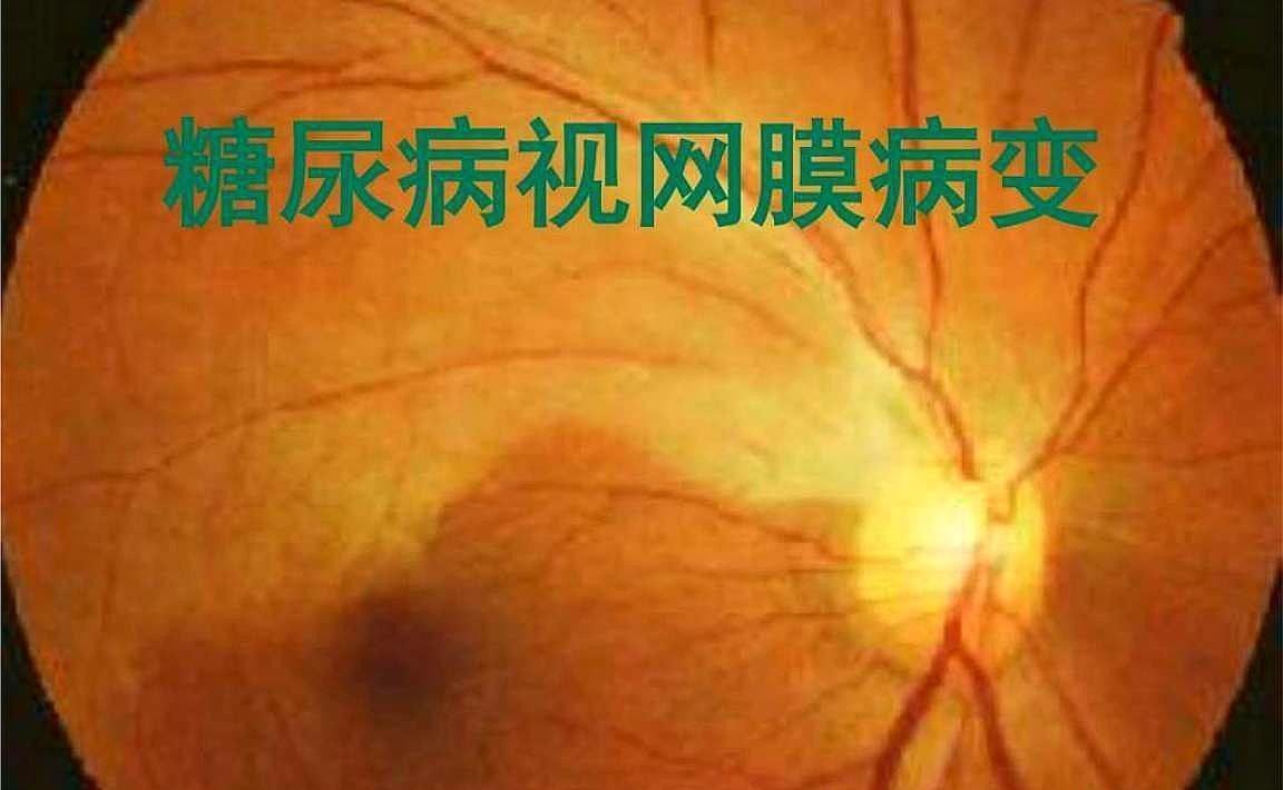 情况|任性大叔国庆参加婚宴，胡吃海喝致眼底出血，到底啥情况