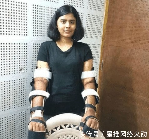 截肢|印度女孩双手截肢后,移植黑人男子手臂,两年后全身皮肤开始变黑