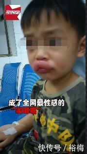  皮肤科主任|全网最性感“嘟嘟嘴”小朋友 背后原因却让更多家长害怕