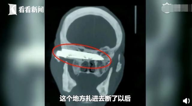 无感|老人遭歹徒抢劫被捅，10厘米尖刀藏脑内26年！因无感把这事忘了……