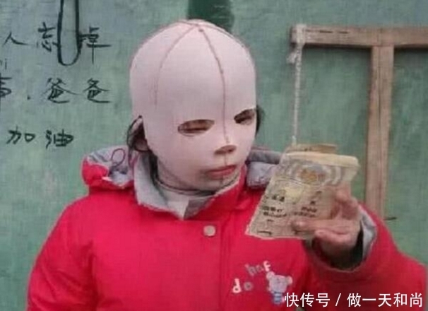  生活|小姑娘因一场车祸毁容，此后戴头套生活4年，当卸下头套后全场鸦雀无声