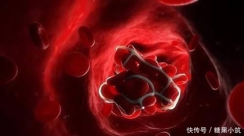 血栓|半瓶醋加上“它”是血栓的“死对头”,让你的血管一通到底!